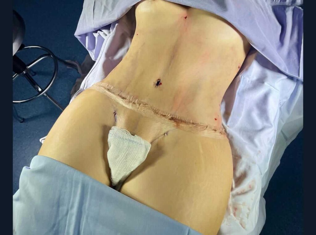 Abdominoplastia en Monterrey 1