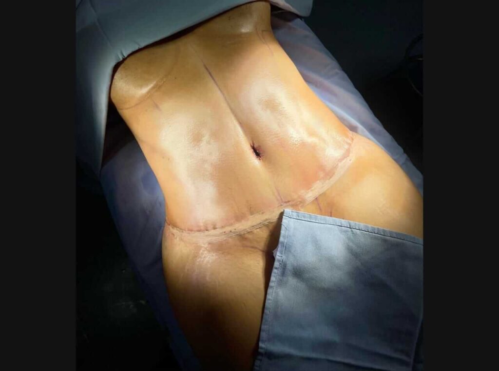 Abdominoplastia en Monterrey