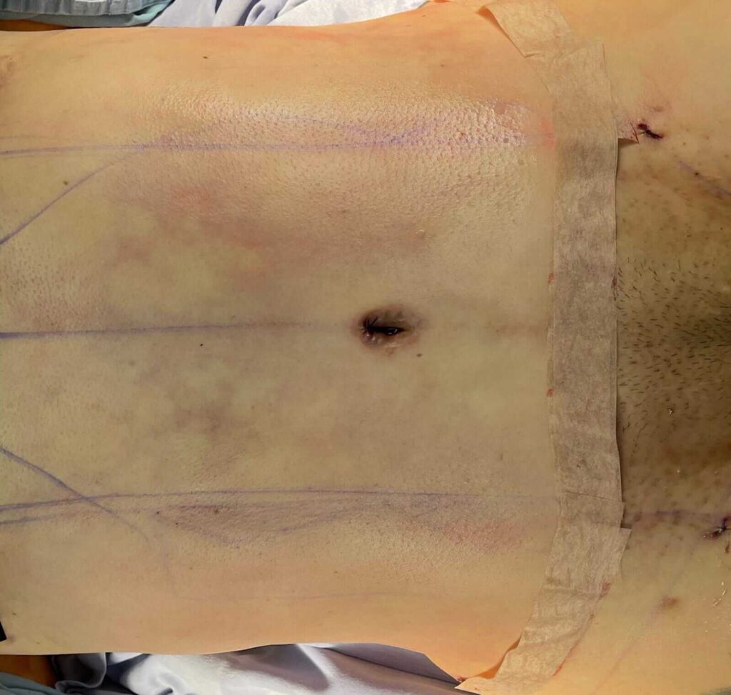 Abdominoplastia en Monterrey 3