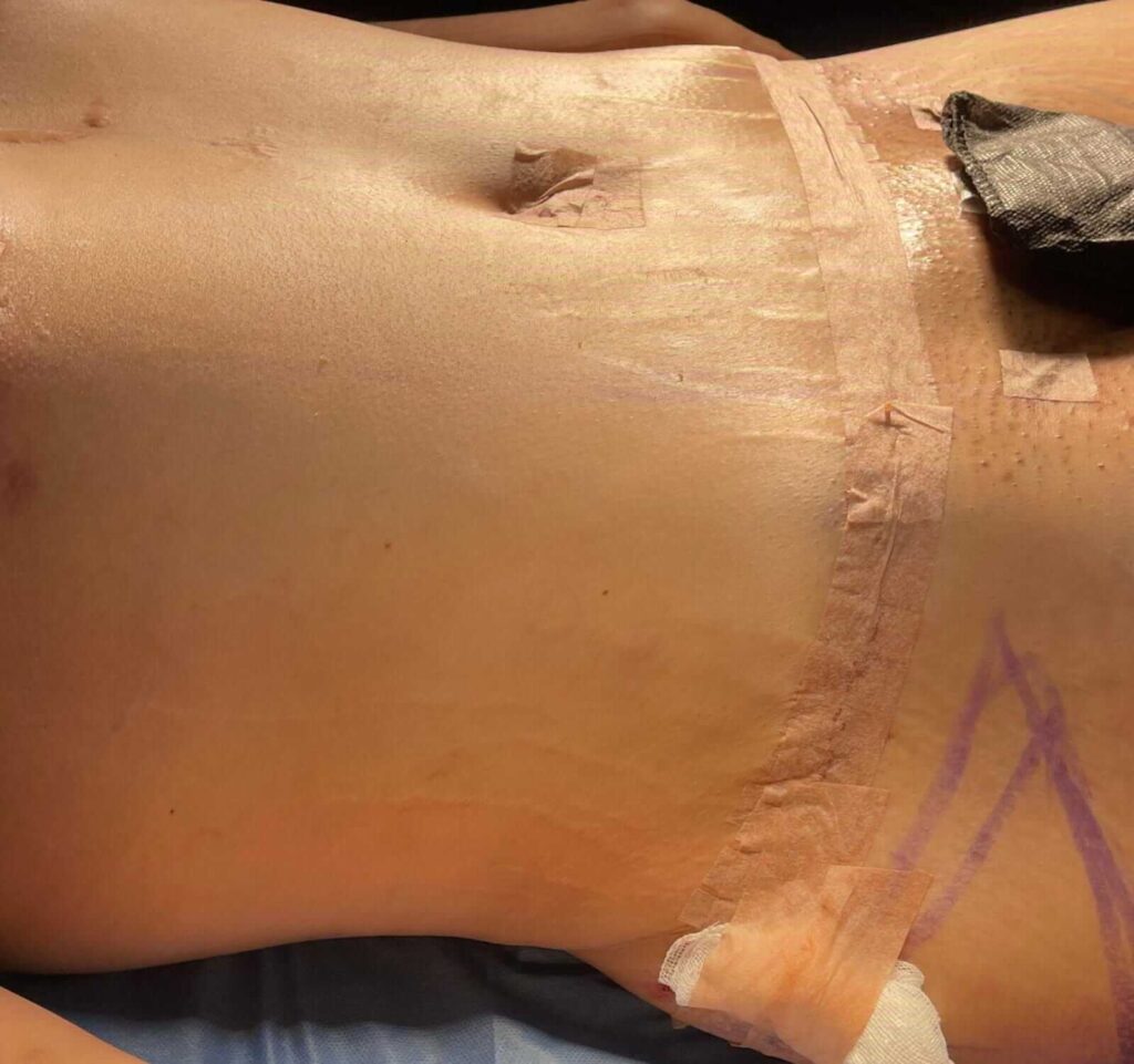 Abdominoplastia en Monterrey 4