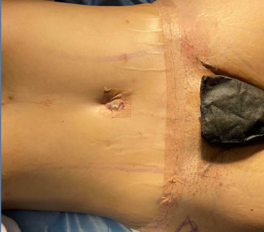 Abdominoplastia en Monterrey 5