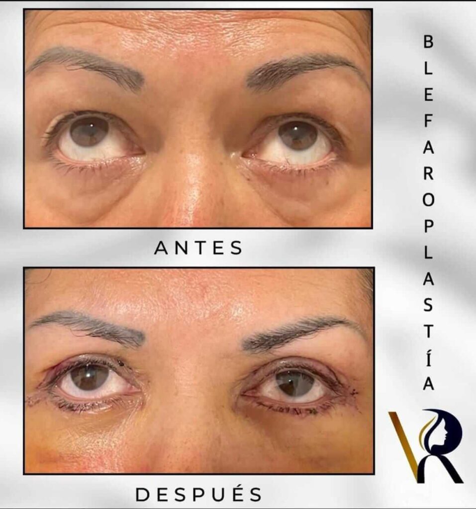 Blefaroplastia en Monterrey 1