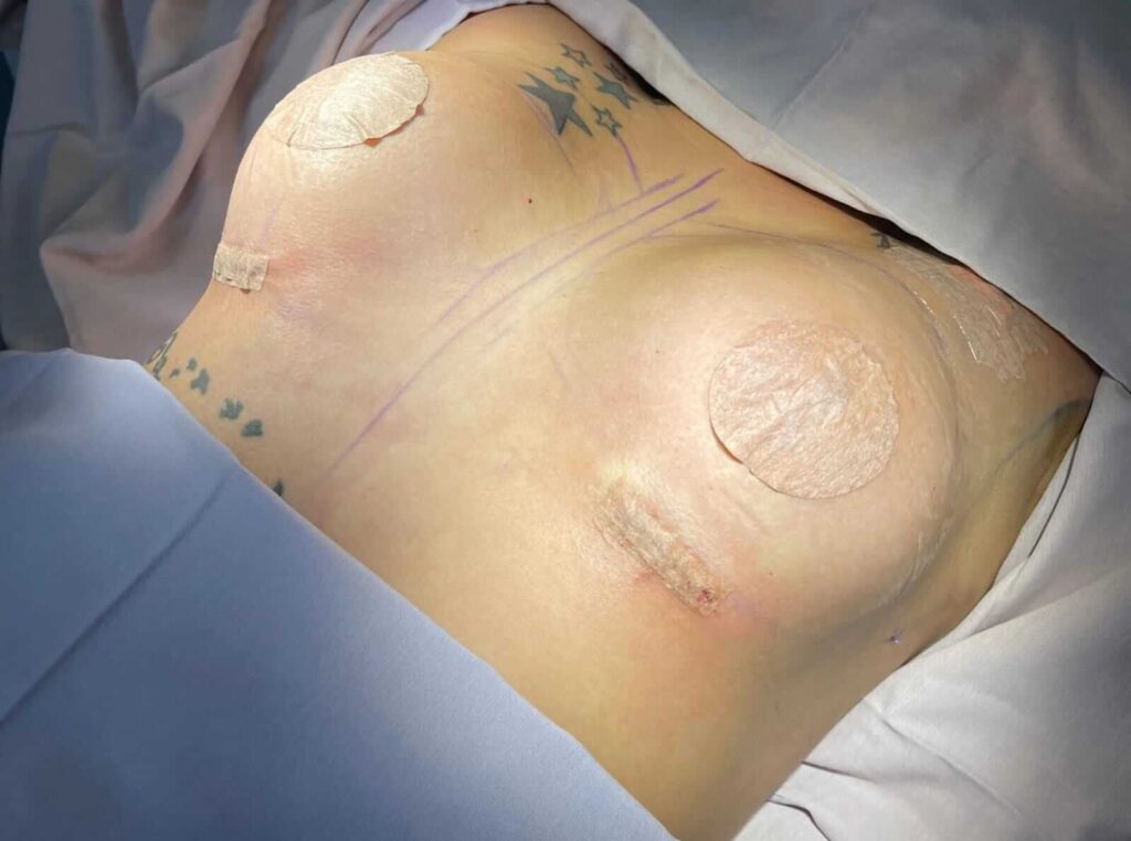 Cirugia de busto en Monterrey 1