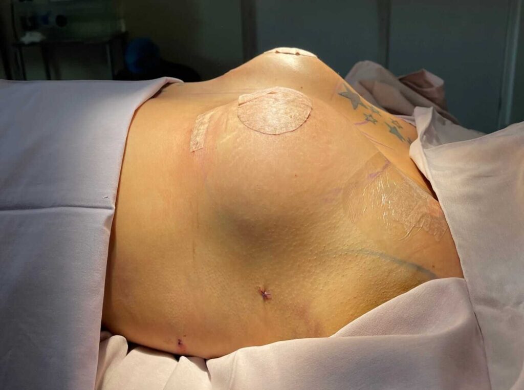 Cirugia de busto en Monterrey