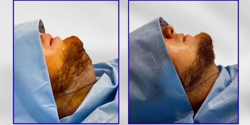 Liposuccion de cuello y papada en Monterrey 1