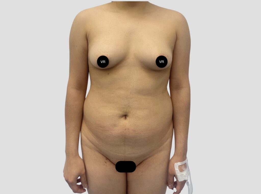 Liposuccion en Monterrey 1 1
