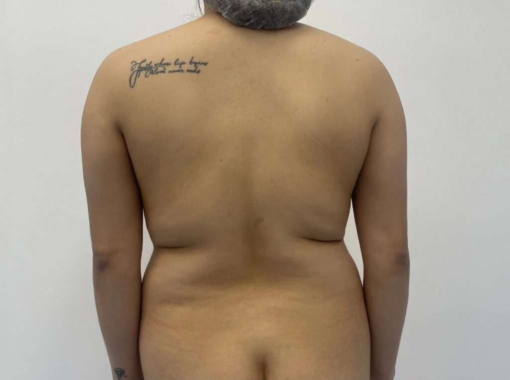 Liposuccion en Monterrey