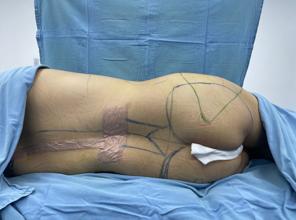 Liposuccion en Monterrey 3