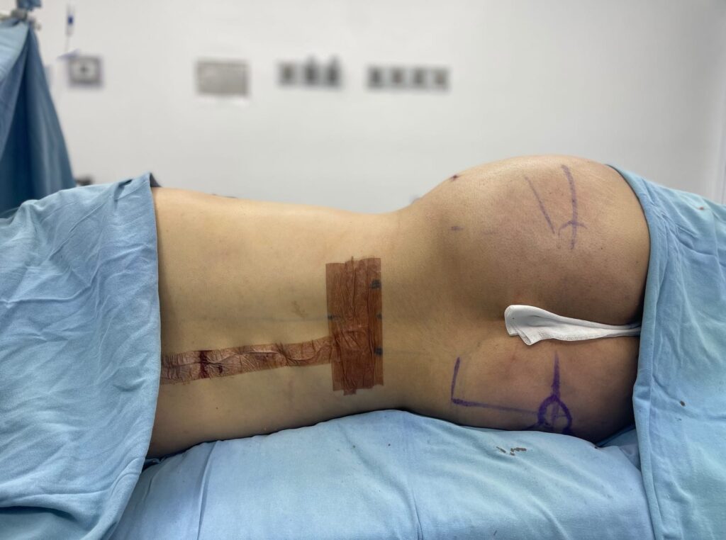 Liposuccion en Monterrey 4