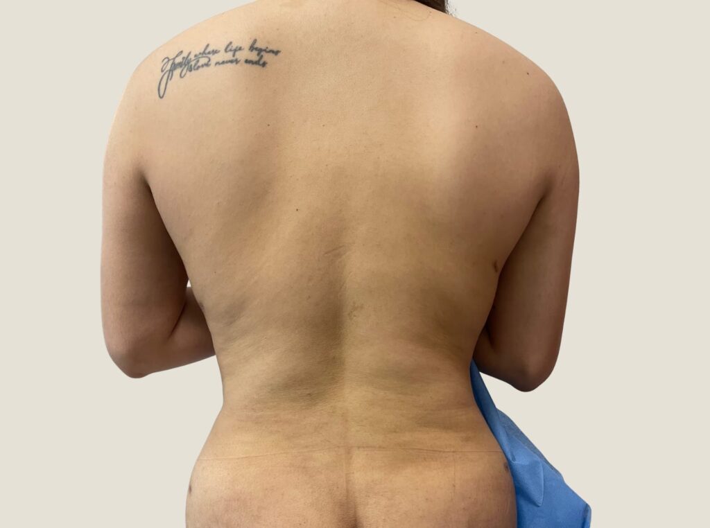 Liposuccion en Monterrey 6