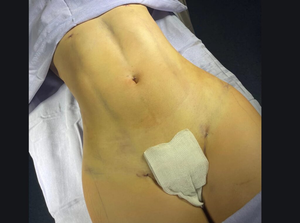 Liposuccion en Monterrey 7