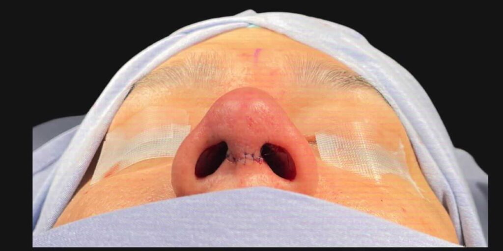 Rinoplastia en Monterrey 1