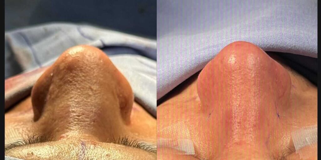 Rinoplastia en Monterrey 2