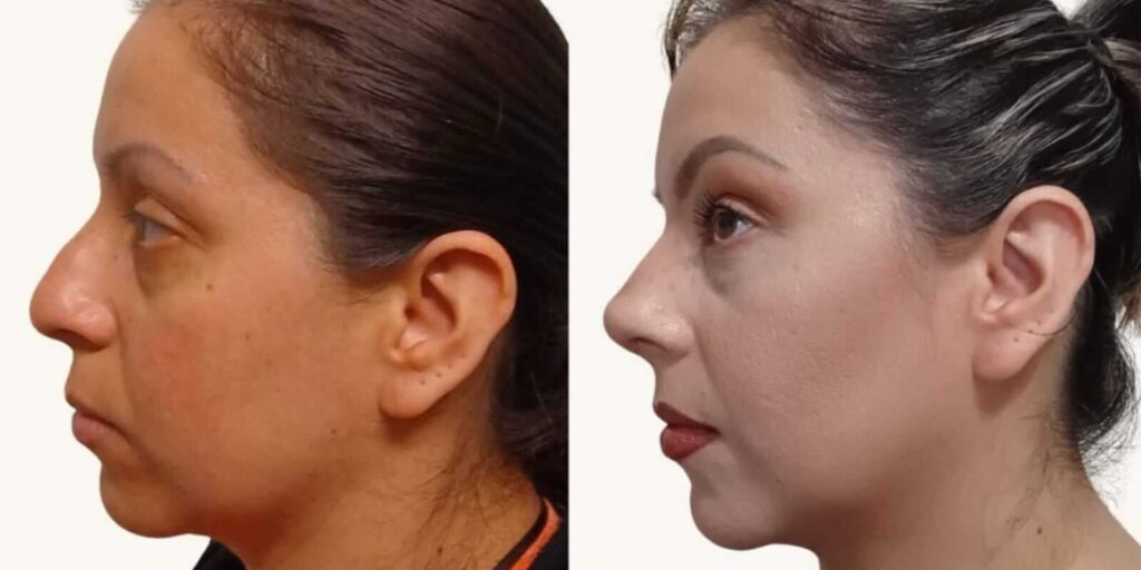 Rinoplastia en Monterrey 3