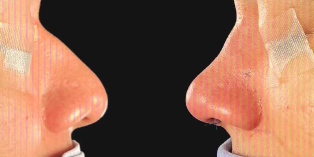 Rinoplastia en Monterrey 4