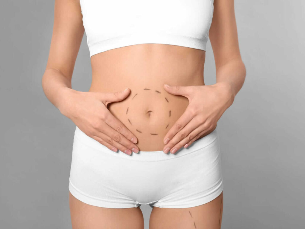 Abdominoplastia en Monterrey Dr. Victor Rodriguez
