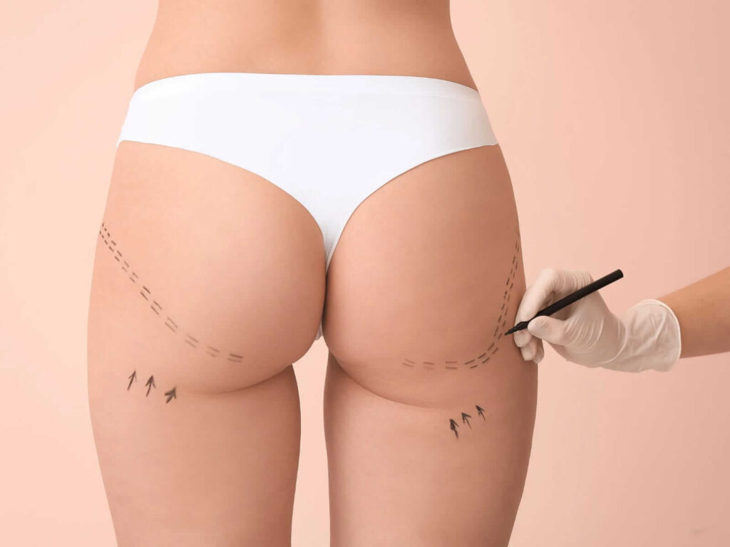 Liposuccion en Monterrey Dr. Victor Rodriguez