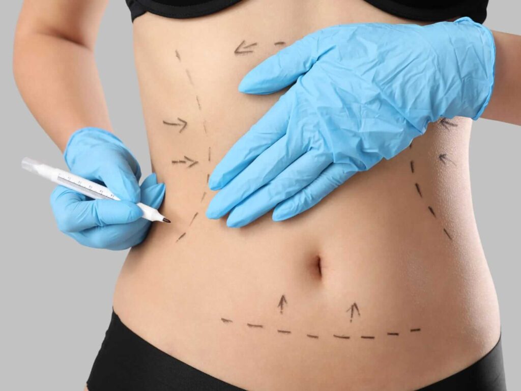 Mommy Makeover en Monterrey Dr. Victor Rodriguez